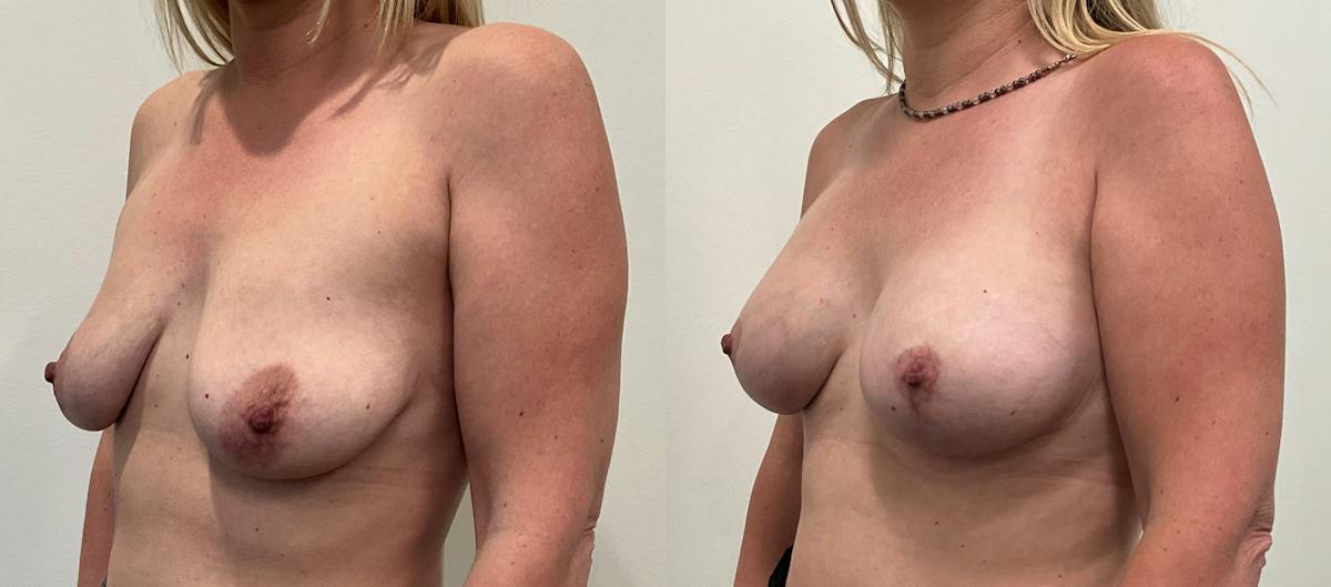Breast Augmentation Before & After Gallery - Patient 136420 - Image 4