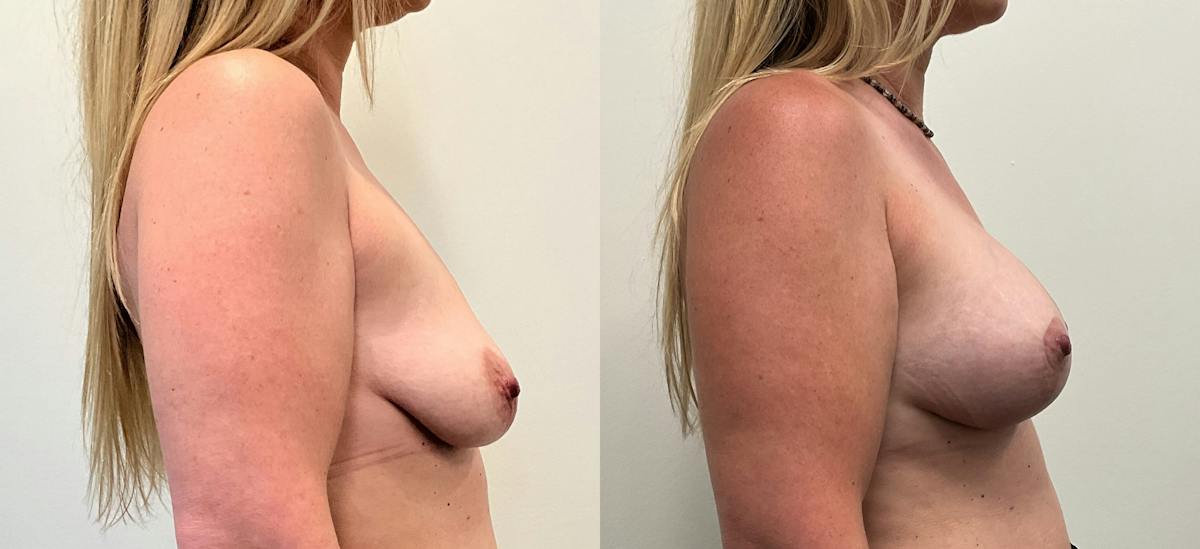 Breast Augmentation Before & After Gallery - Patient 136420 - Image 3