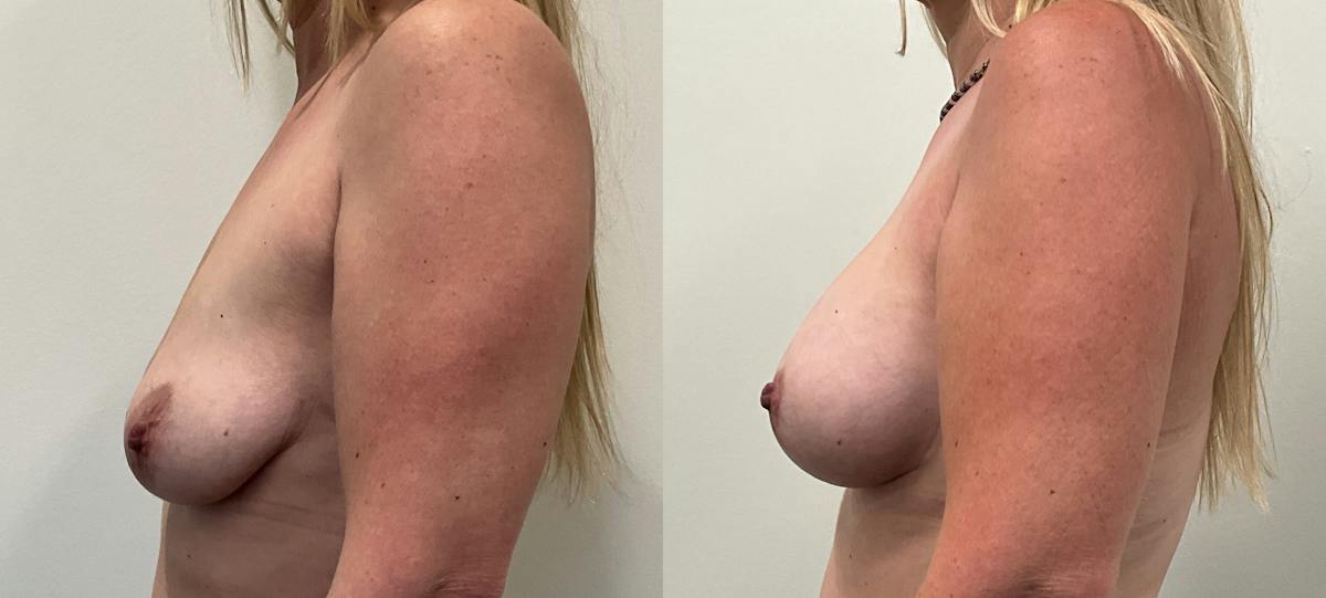 Breast Augmentation Before & After Gallery - Patient 136420 - Image 5