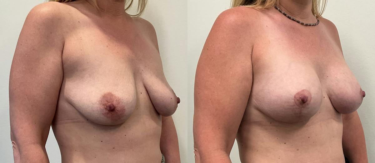 Breast Augmentation Before & After Gallery - Patient 136420 - Image 2