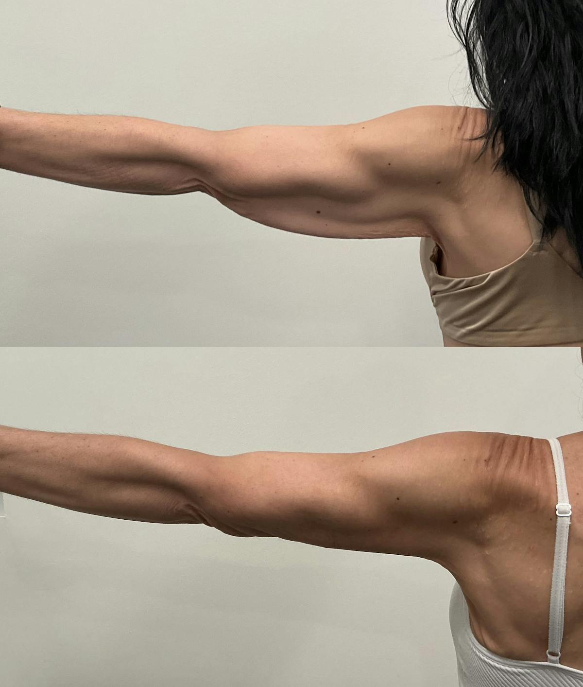 Arm Lift Before & After Gallery - Patient 195079 - Image 2