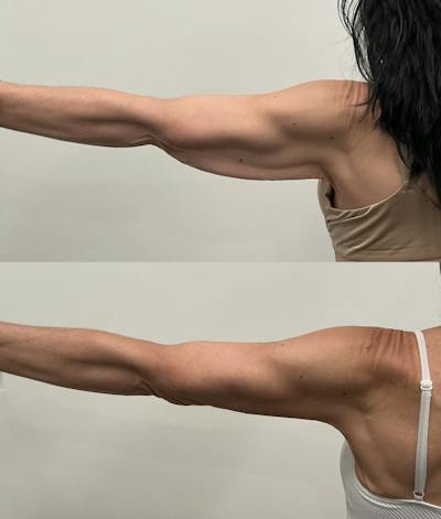 Arm Lift Before & After Gallery - Patient 195079 - Image 2