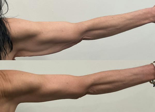 Arm Lift Before & After Gallery - Patient 195079 - Image 1