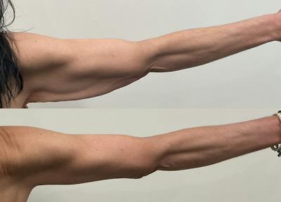 Arm Lift Before & After Gallery - Patient 195079 - Image 1
