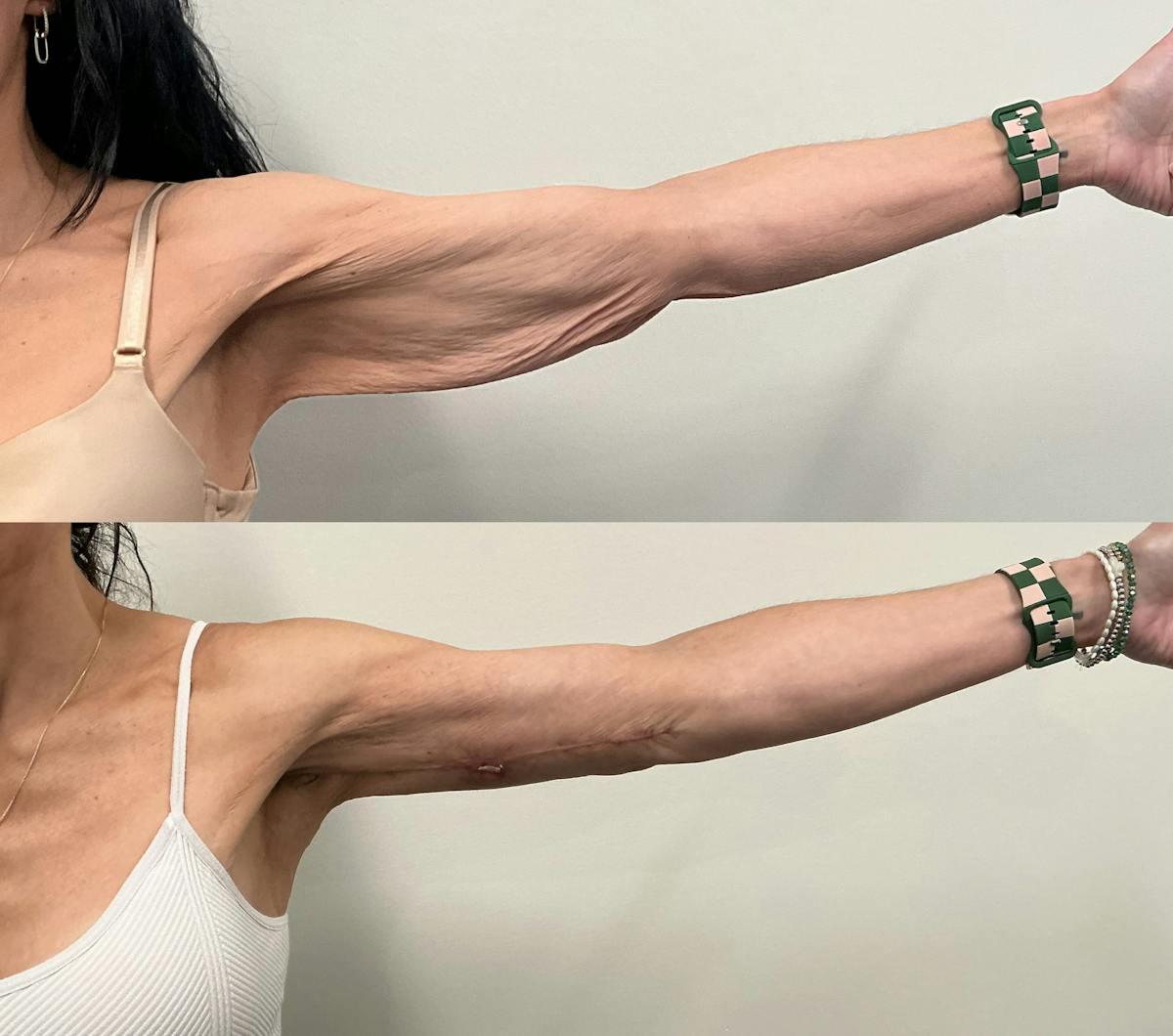 Arm Lift Before & After Gallery - Patient 195079 - Image 4