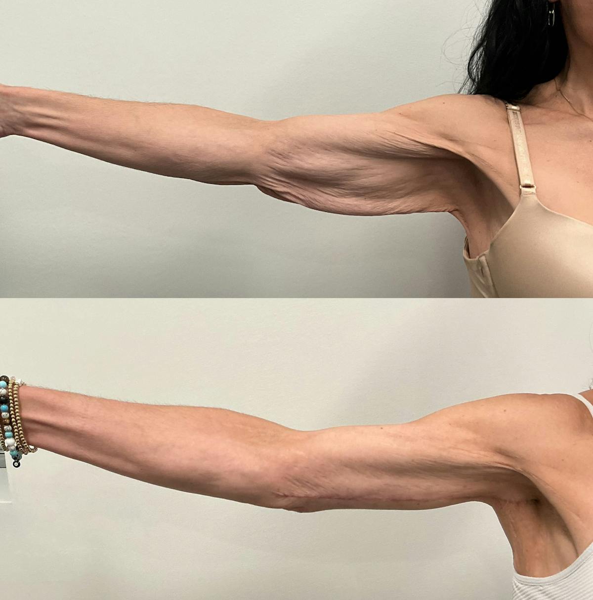 Arm Lift Before & After Gallery - Patient 195079 - Image 3