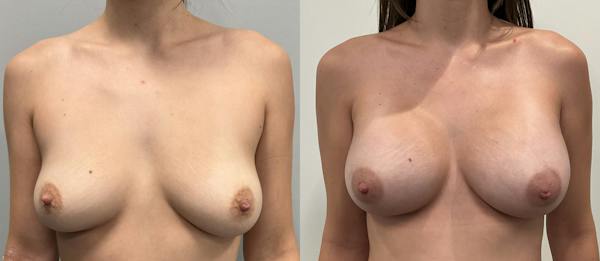 Breast Augmentation Before & After Gallery - Patient 807055 - Image 1