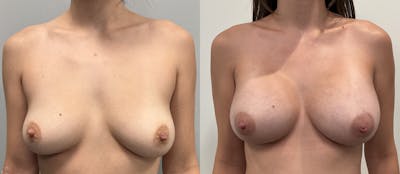 Breast Augmentation Before & After Gallery - Patient 807055 - Image 1