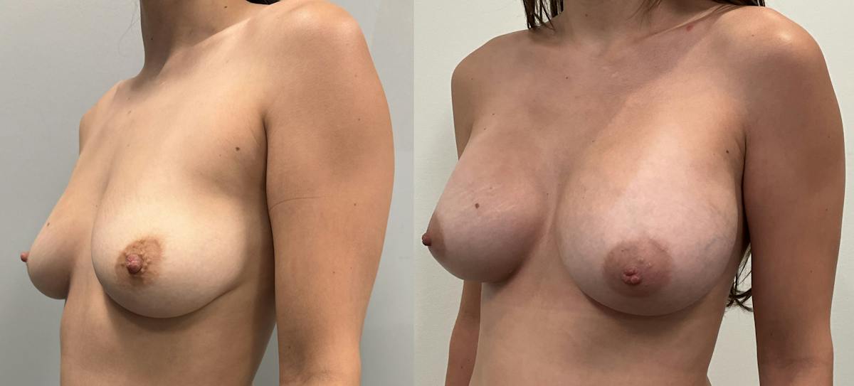 Breast Augmentation Before & After Gallery - Patient 807055 - Image 4