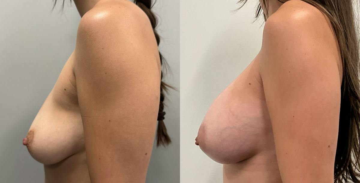 Breast Augmentation Before & After Gallery - Patient 807055 - Image 5