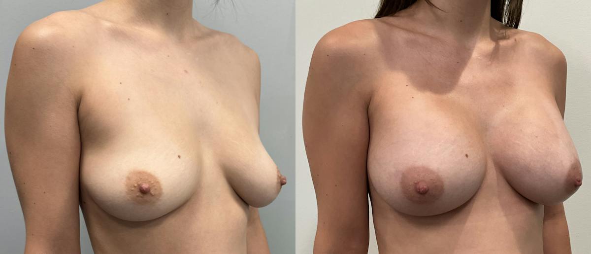 Breast Augmentation Before & After Gallery - Patient 807055 - Image 2