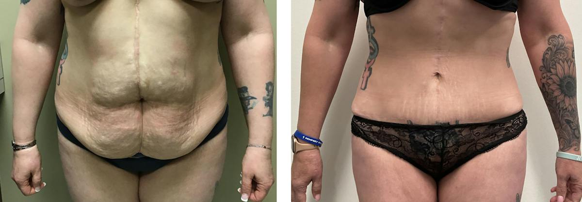 Tummy Tuck Before & After Gallery - Patient 127883 - Image 2