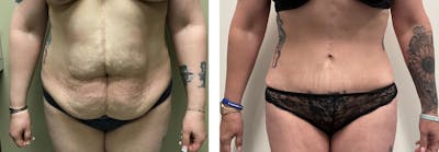 Tummy Tuck Before & After Gallery - Patient 127883 - Image 2
