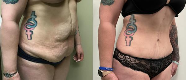 Tummy Tuck Before & After Gallery - Patient 127883 - Image 1