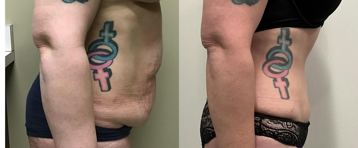 Tummy Tuck Before & After Gallery - Patient 127883 - Image 3