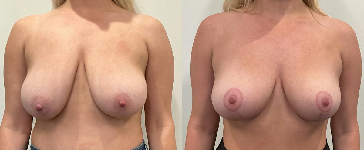 Breast Augmentation Before & After Gallery - Patient 351947 - Image 1
