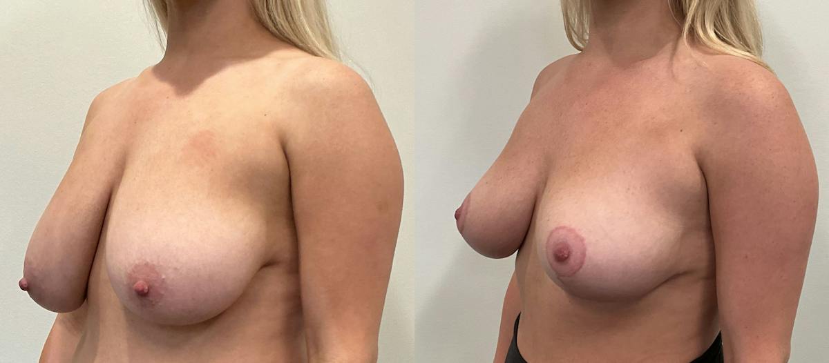 Breast Augmentation Before & After Gallery - Patient 351947 - Image 2