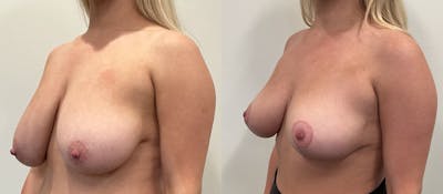 Breast Augmentation Before & After Gallery - Patient 351947 - Image 2