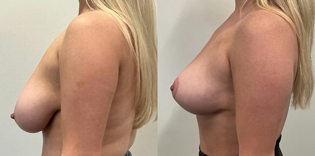 Breast Augmentation Before & After Gallery - Patient 351947 - Image 3