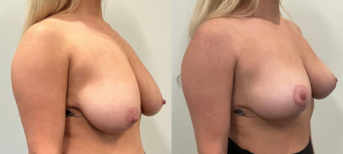 Breast Augmentation Before & After Gallery - Patient 351947 - Image 4