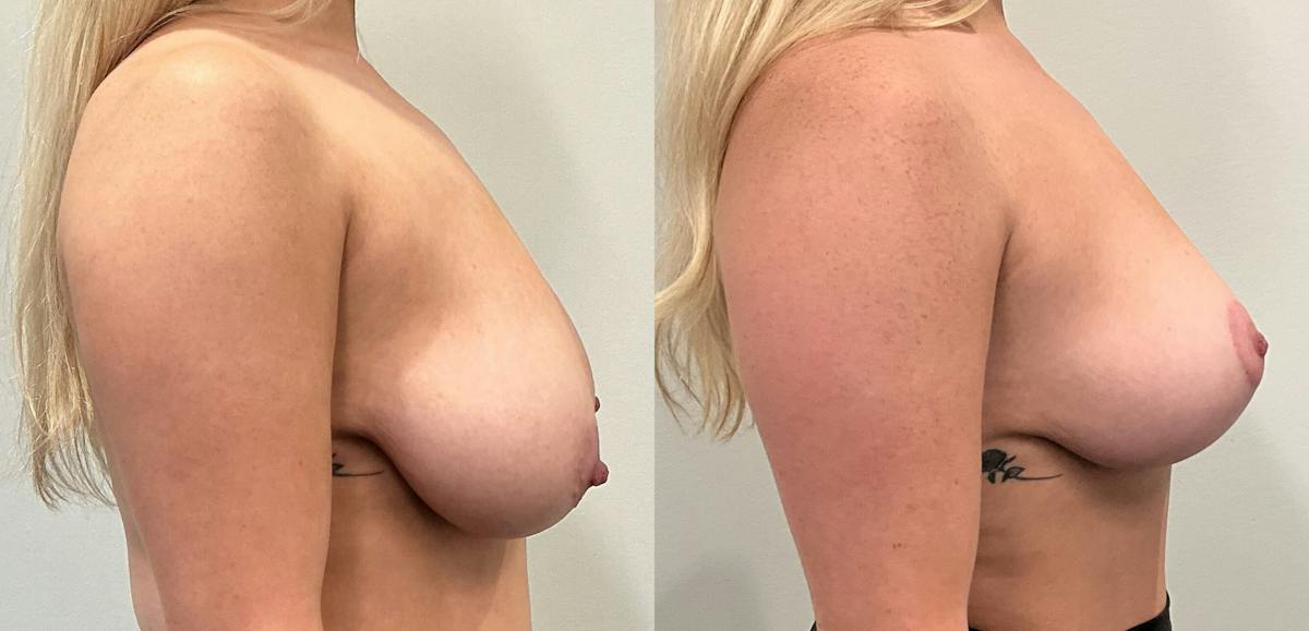 Breast Augmentation Before & After Gallery - Patient 351947 - Image 5