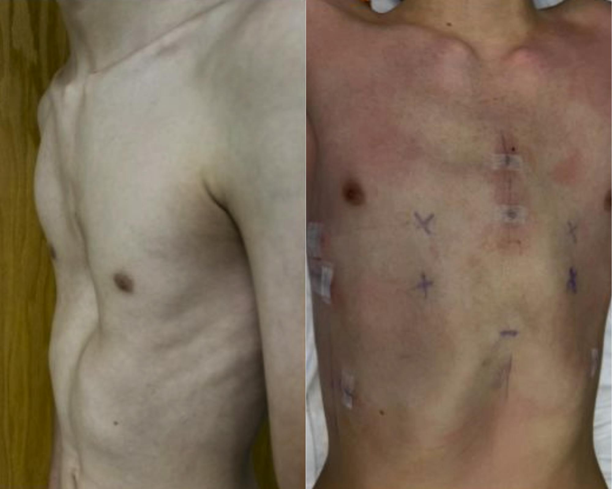 Chest Wall Surgery: A Physical and Mental Quality of Life Treatment