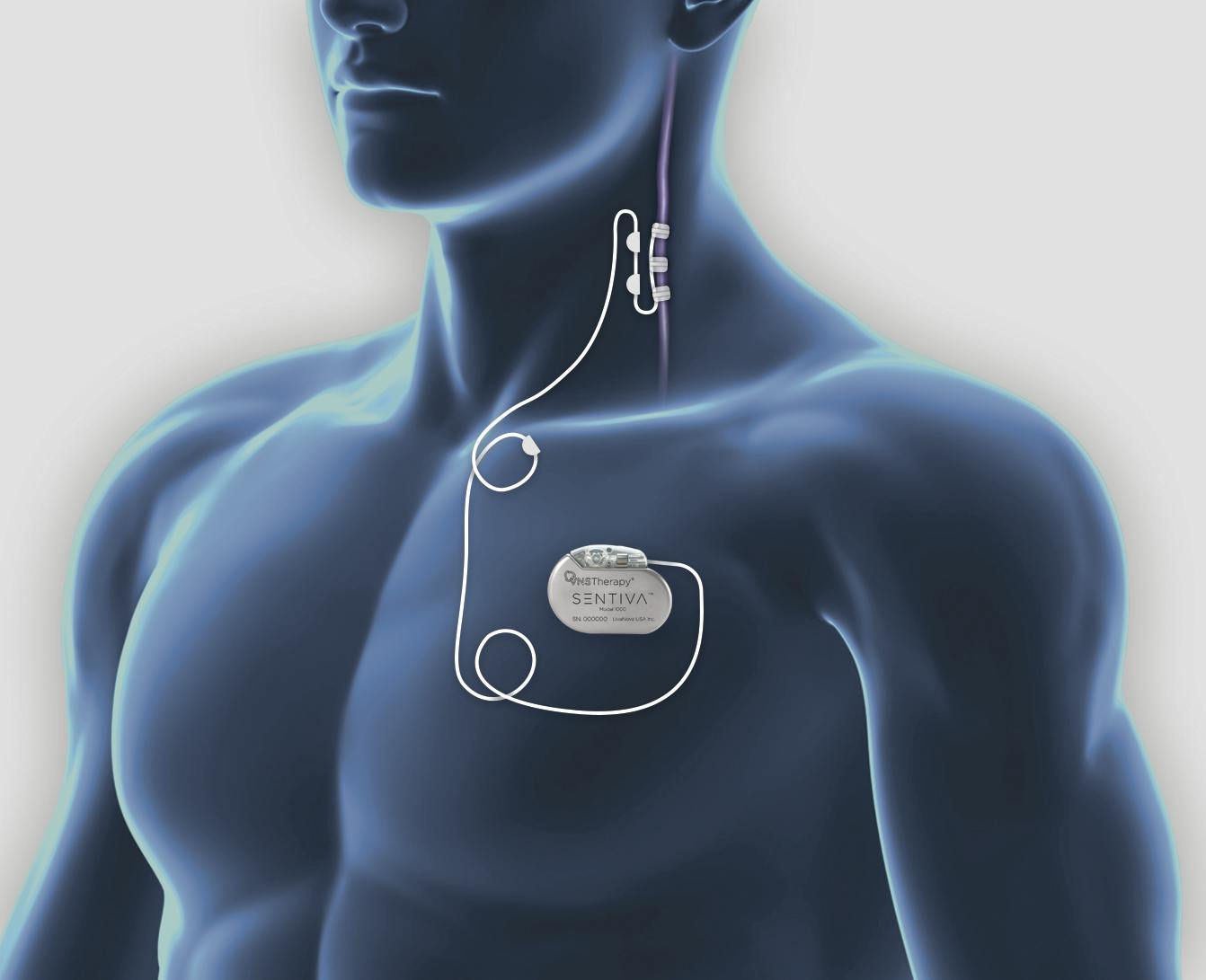 Understanding Vagus Nerve Stimulation (VNS) for Epilepsy in Adults and Children