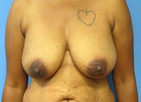 Breast Reconstruction - Flap Gallery - Patient 3831107 - Image 1