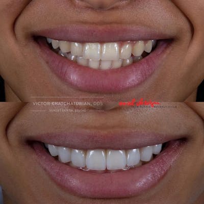 Gallery Before & After Gallery - Patient 4387399 - Image 1