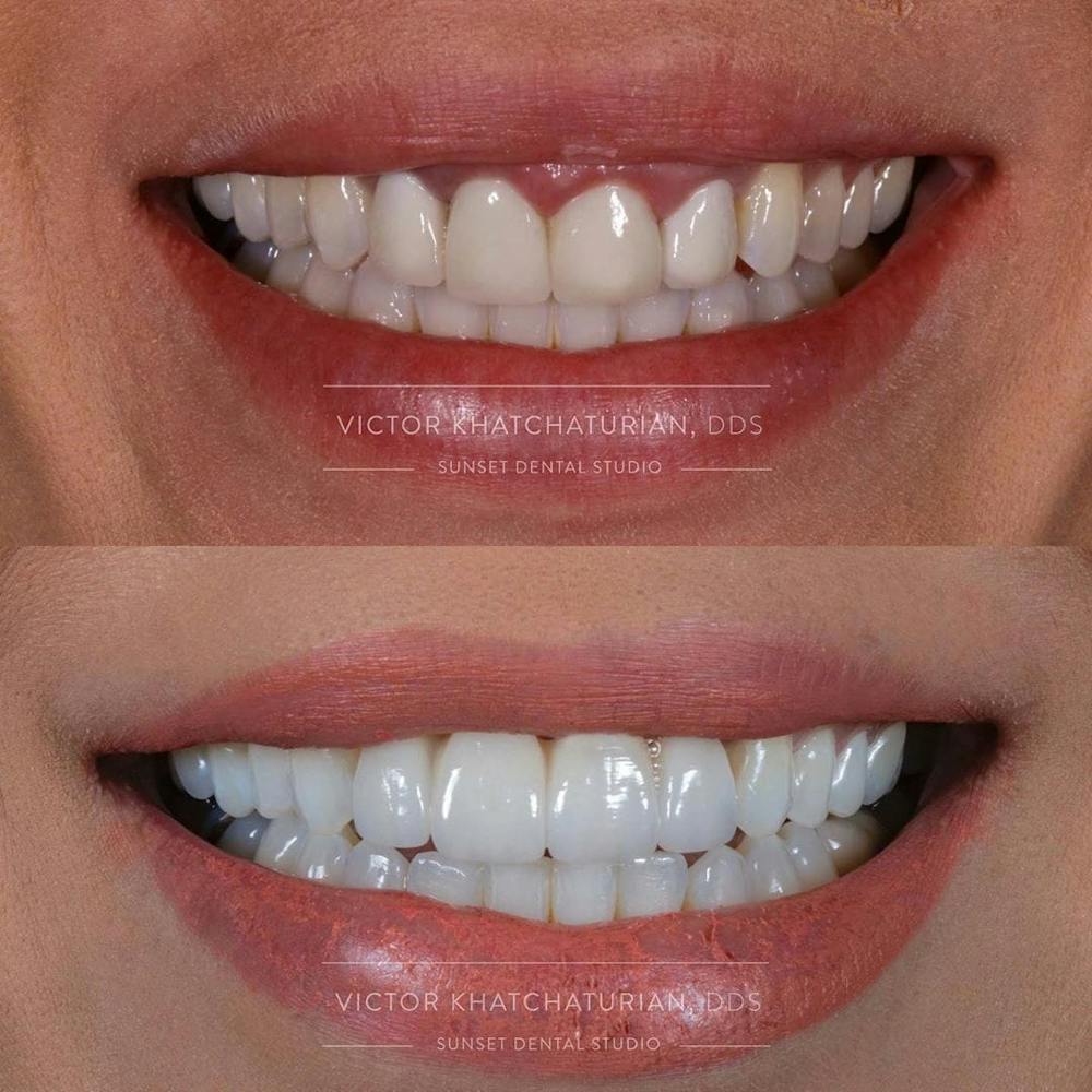 Gallery Before & After Gallery - Patient 4387400 - Image 1