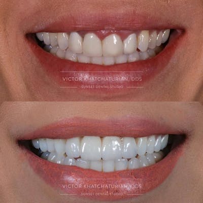 Gallery Before & After Gallery - Patient 4387400 - Image 1