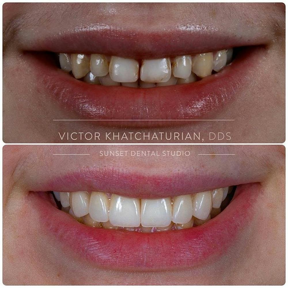 Gallery Before & After Gallery - Patient 4387402 - Image 1