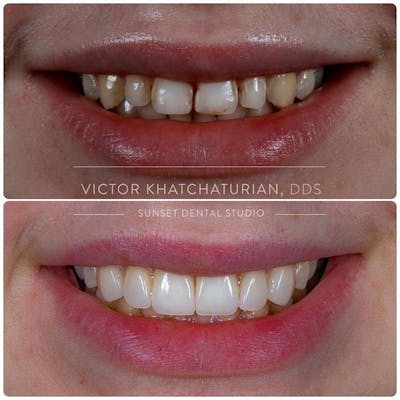 Gallery Before & After Gallery - Patient 4387402 - Image 1