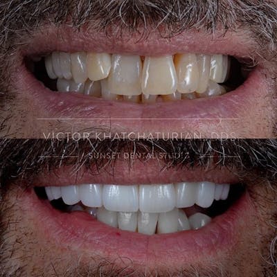 Gallery Before & After Gallery - Patient 4387403 - Image 1