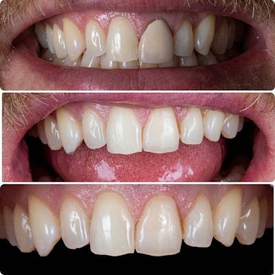 Gallery Before & After Gallery - Patient 4387404 - Image 1