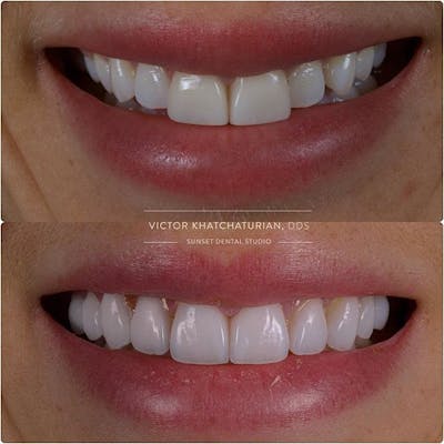Gallery Before & After Gallery - Patient 4387405 - Image 1
