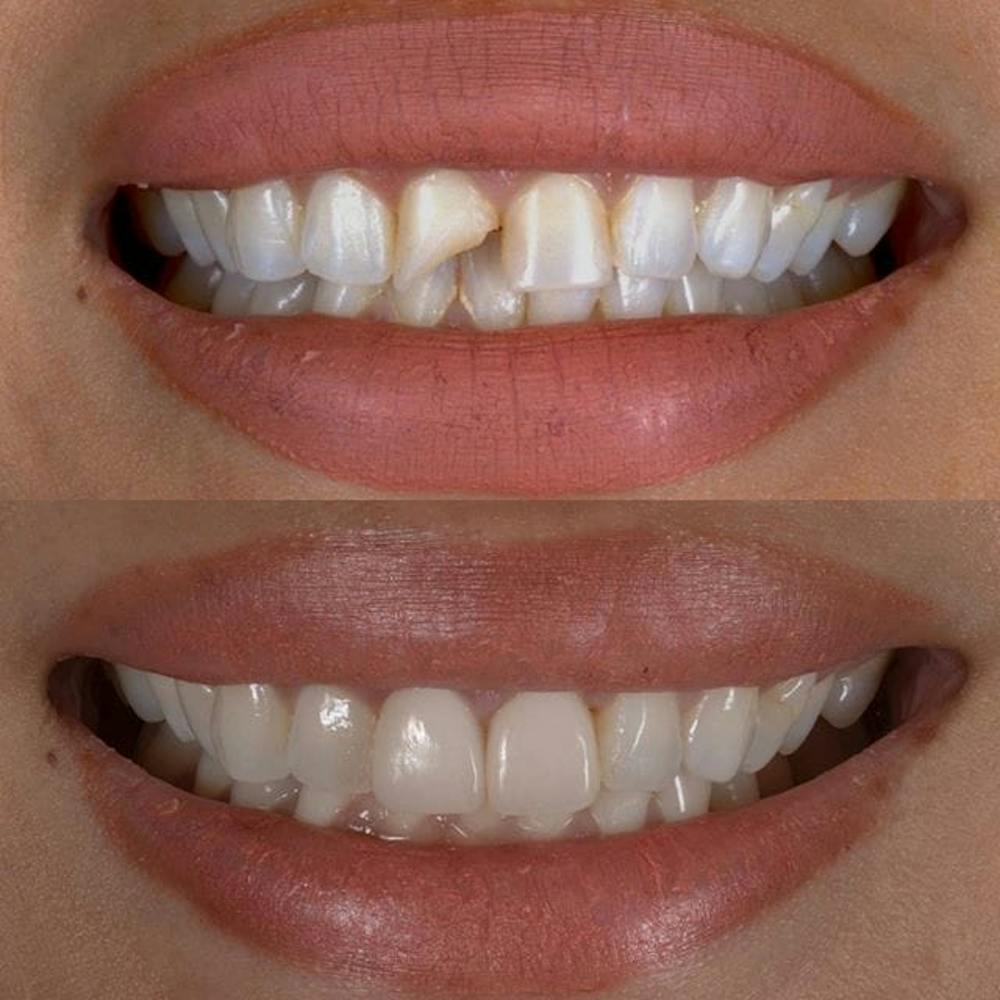 Gallery Before & After Gallery - Patient 4387406 - Image 1