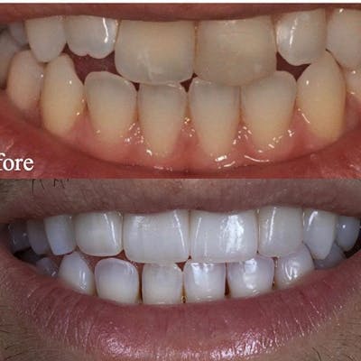 Gallery Before & After Gallery - Patient 4387408 - Image 1