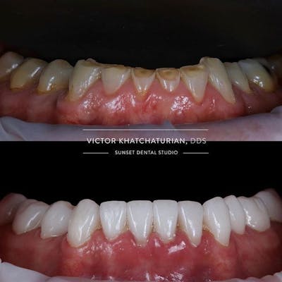 Gallery Before & After Gallery - Patient 4387411 - Image 1