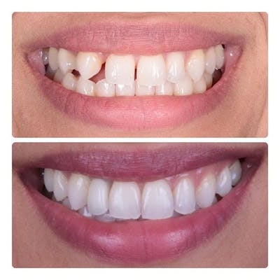 Gallery Before & After Gallery - Patient 4387412 - Image 1