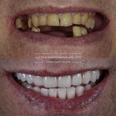 Gallery Before & After Gallery - Patient 4387414 - Image 1