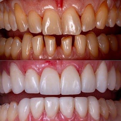 Gallery Before & After Gallery - Patient 4387415 - Image 1