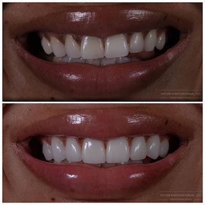 Gallery Before & After Gallery - Patient 4387416 - Image 1