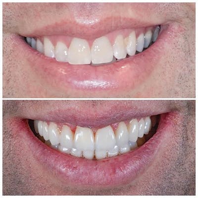 Gallery Before & After Gallery - Patient 4387417 - Image 1