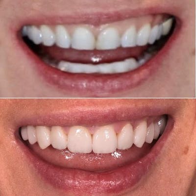 Gallery Before & After Gallery - Patient 4387418 - Image 1