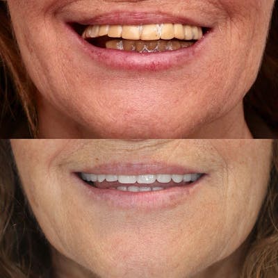 Gallery Before & After Gallery - Patient 4387419 - Image 1
