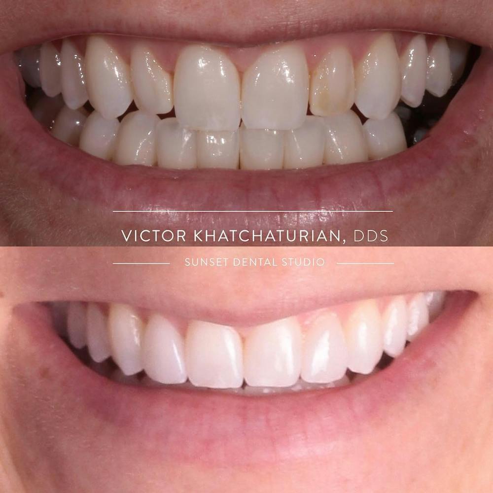 Gallery Before & After Gallery - Patient 4387420 - Image 1
