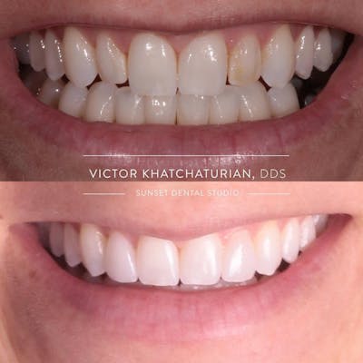 Gallery Before & After Gallery - Patient 4387420 - Image 1