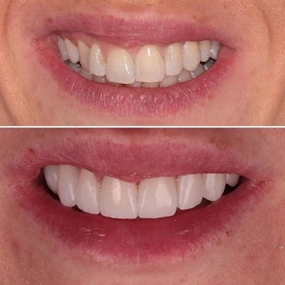 Gallery Before & After Gallery - Patient 4387421 - Image 1