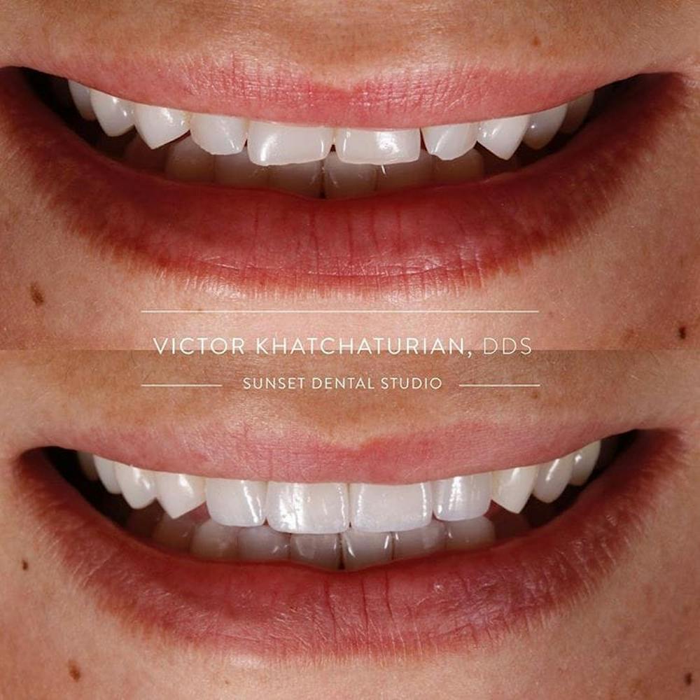 Gallery Before & After Gallery - Patient 4387422 - Image 1